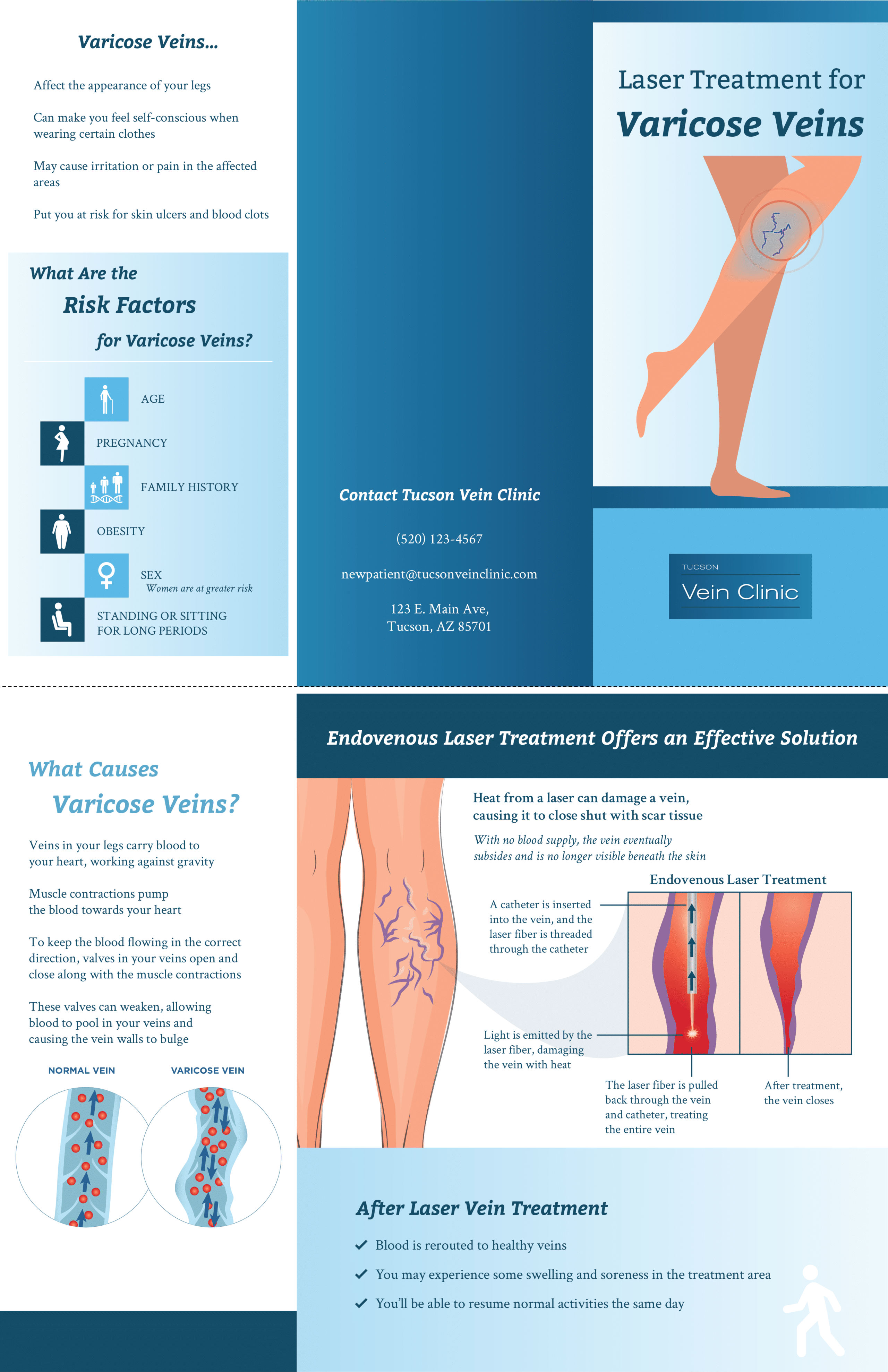 Brochure explaining laser treatment for varicose veins.